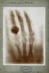 V0029523 X-ray of the bones of a hand with a ring on one finger